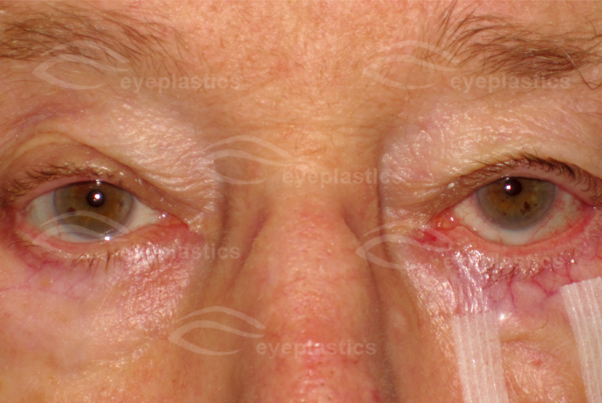 An image showing an eye affected by entropion, a condition where the eyelid folds inward.