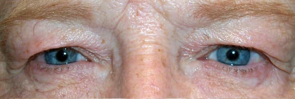 Dermatochalasis — exceso de piel del párpado superior colgante sobre un margen normal del párpado