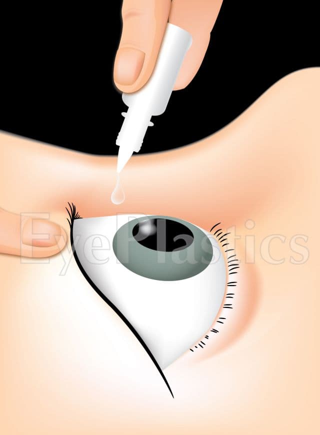 Instilación de gotas de fenilefrina al 2,5% (Neo-Synephrine) para probar la respuesta del músculo de Müller en ptosis
