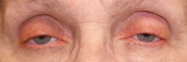 Ptosis — ambos márgenes del párpado superior caen bajo a través de los ojos