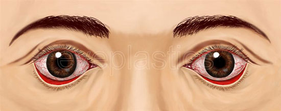 Clinical photograph of ectropion &mdash; lower eyelid turning outward