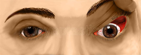 Floppy eyelid syndrome &mdash; easily everted upper eyelid