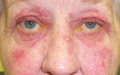Facial rosacea — erythema and telangiectasias