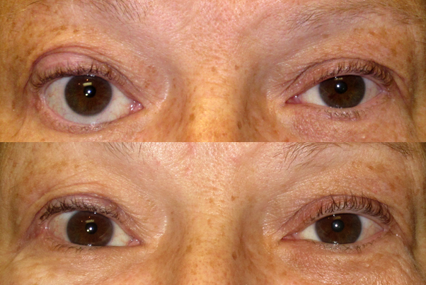 Thyroid eye disease &mdash; axial CT showing muscle enlargement